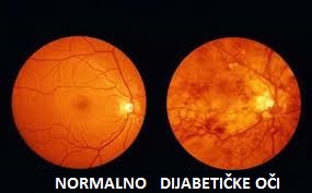 dijabetička retinopatija